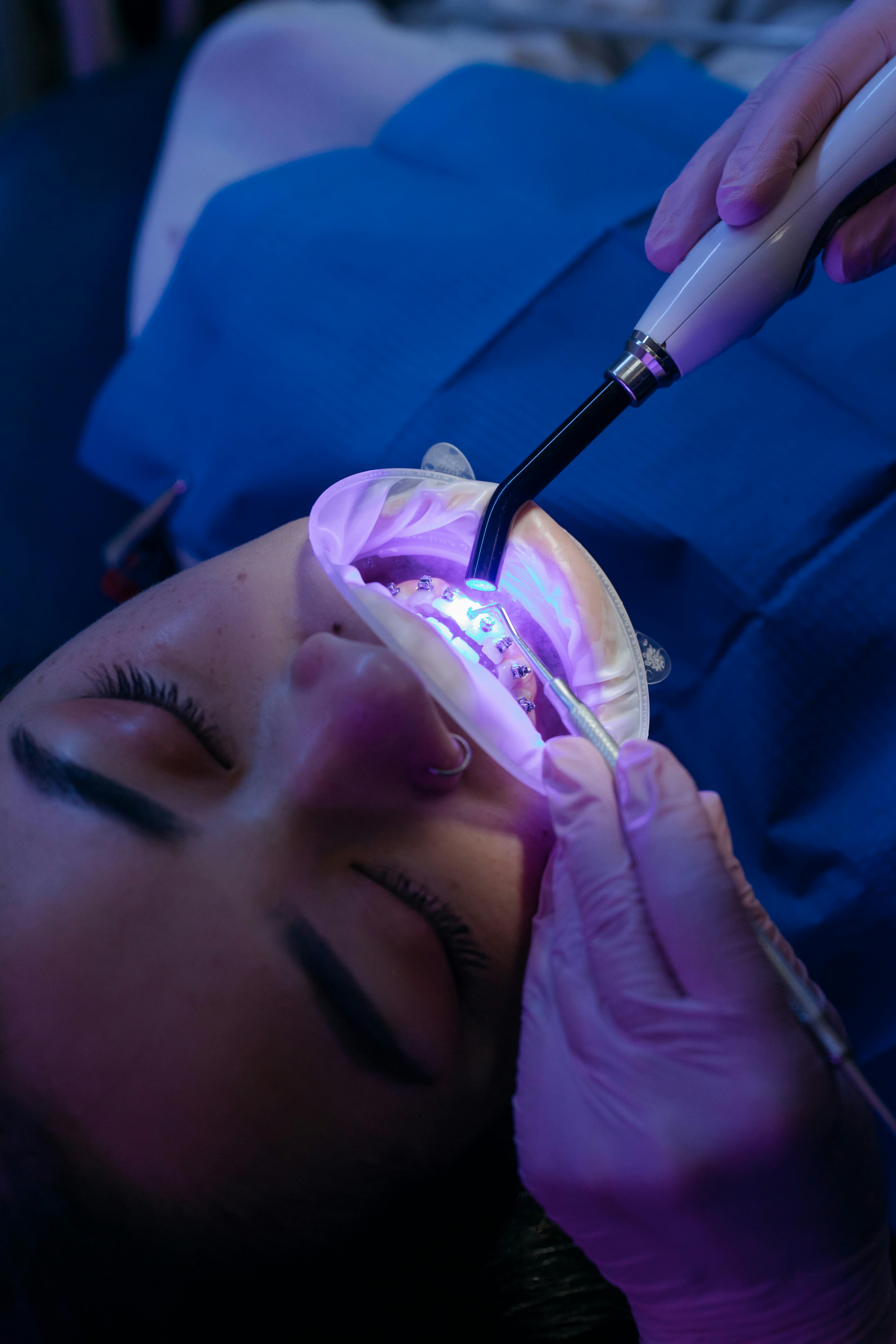Professional teeth whitening at Lume Dental